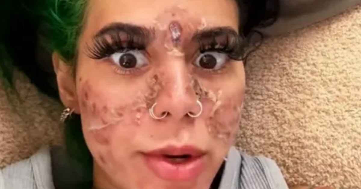 Beasteater Chemical Burn: What Happened To Beasteater Face?